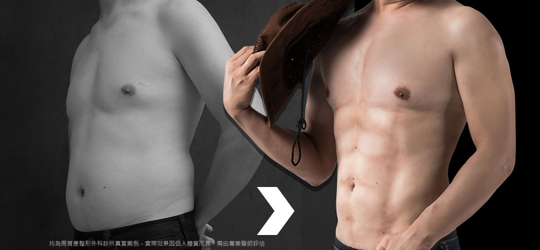 男性女乳症案例-上胸厚實飽滿,下胸界線分明