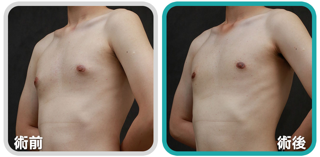 乳腺型男性女乳症案例01，經過手術後乳頭激凸問題改善，恢復正常男性胸型