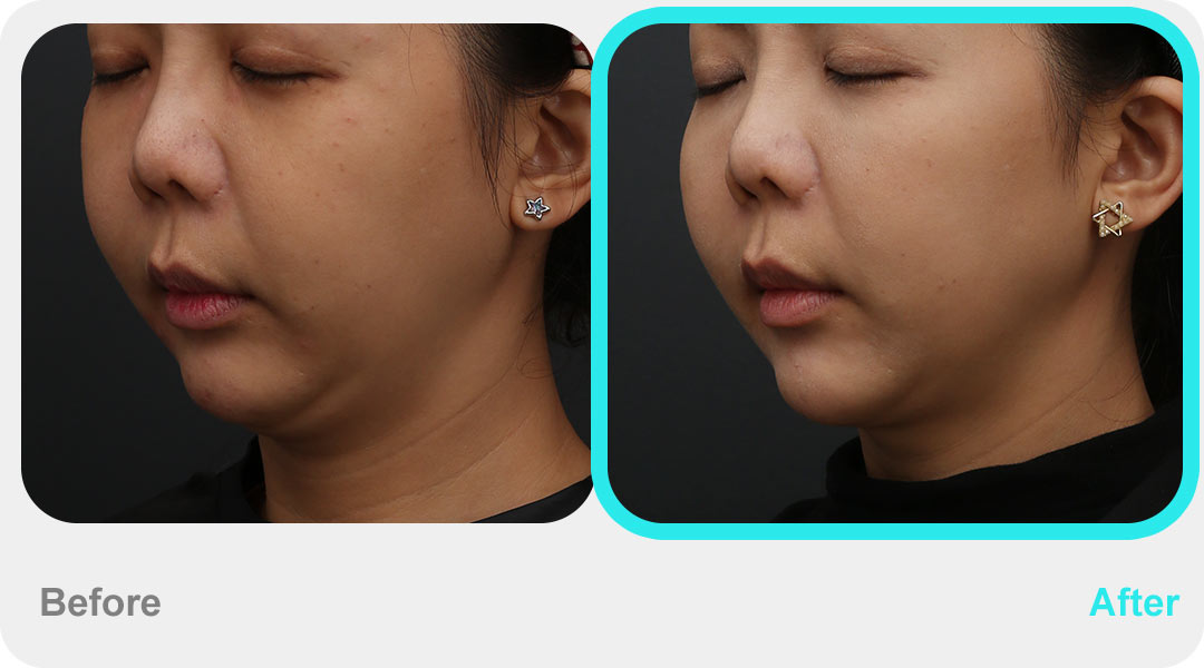 Inmode LIFT 鑽石超塑雙下巴治療效果0案例03