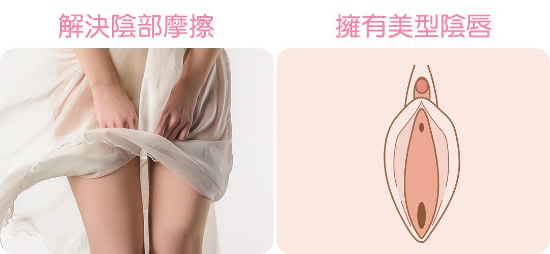私密處整形/小陰唇手術治療(解決陰部摩擦/擁有美型陰唇)