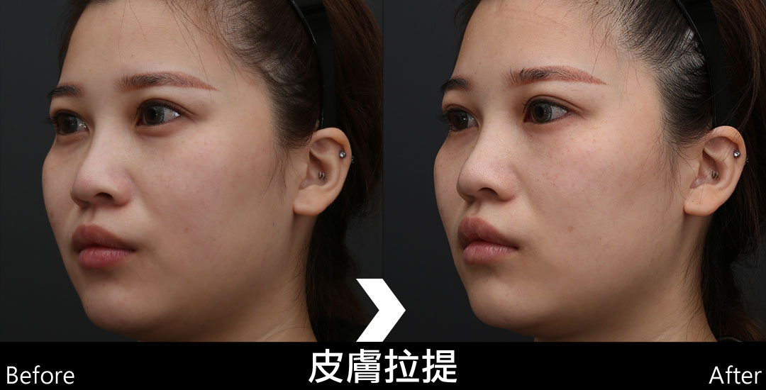 音波拉提治療效果｜下顎線拉提｜03