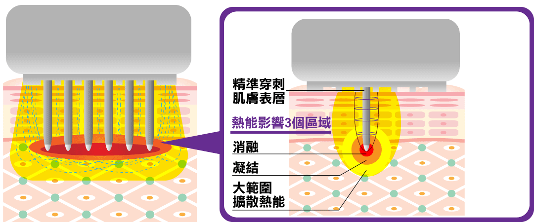 微針電波:墨菲斯