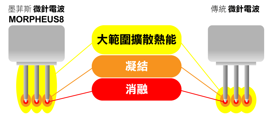 MORPHEUS8微針電波(夢神電波)VS傳統微針電波