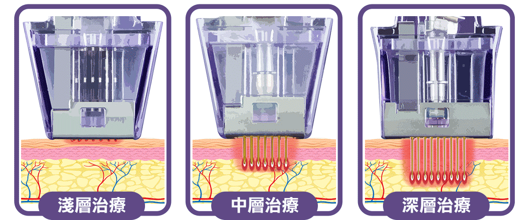 微針電波|MORPHEUS8|墨菲斯電波