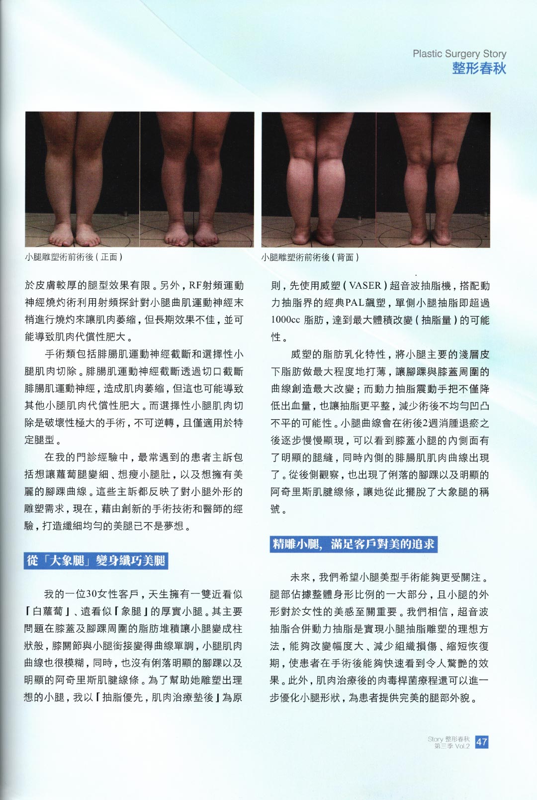 【轉載】整形春秋雜誌|蘿蔔腿小象腿該怎麼變成纖纖玉腿?小腿抽脂小腿雕塑完成體雕的終極拼圖