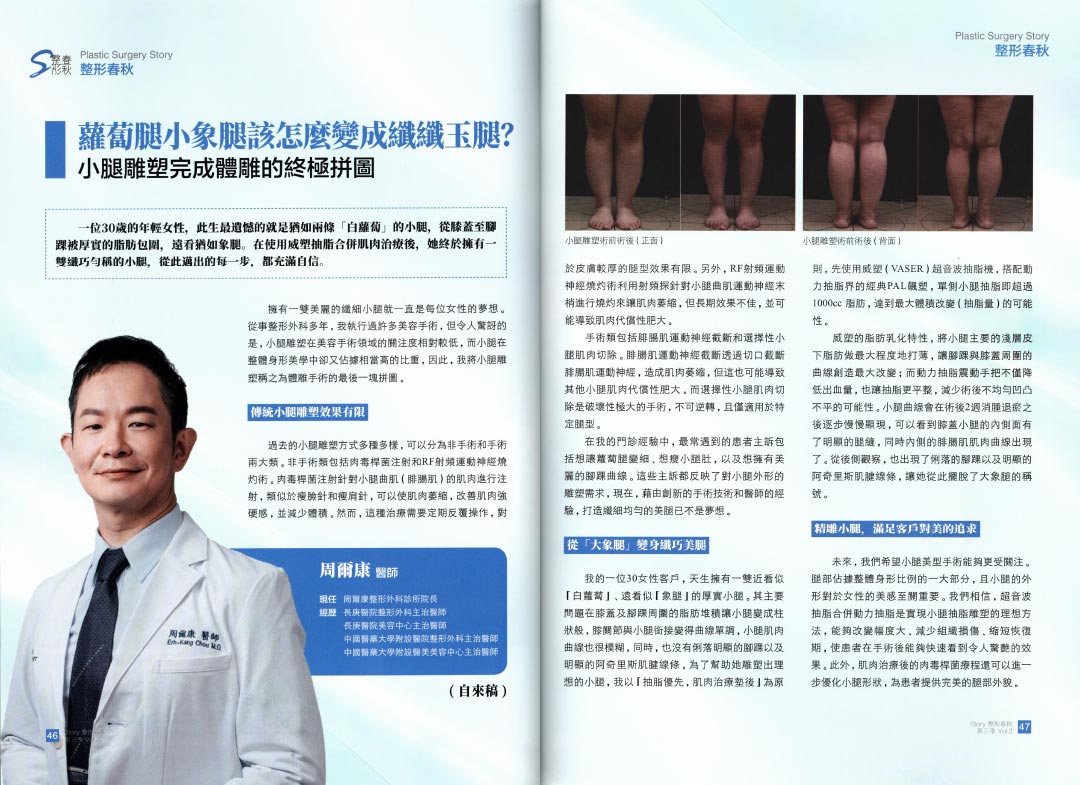 2025小腿抽脂推薦｜手術方式、費用、後遺症、ptt網友心得，讓你安心執行手術！