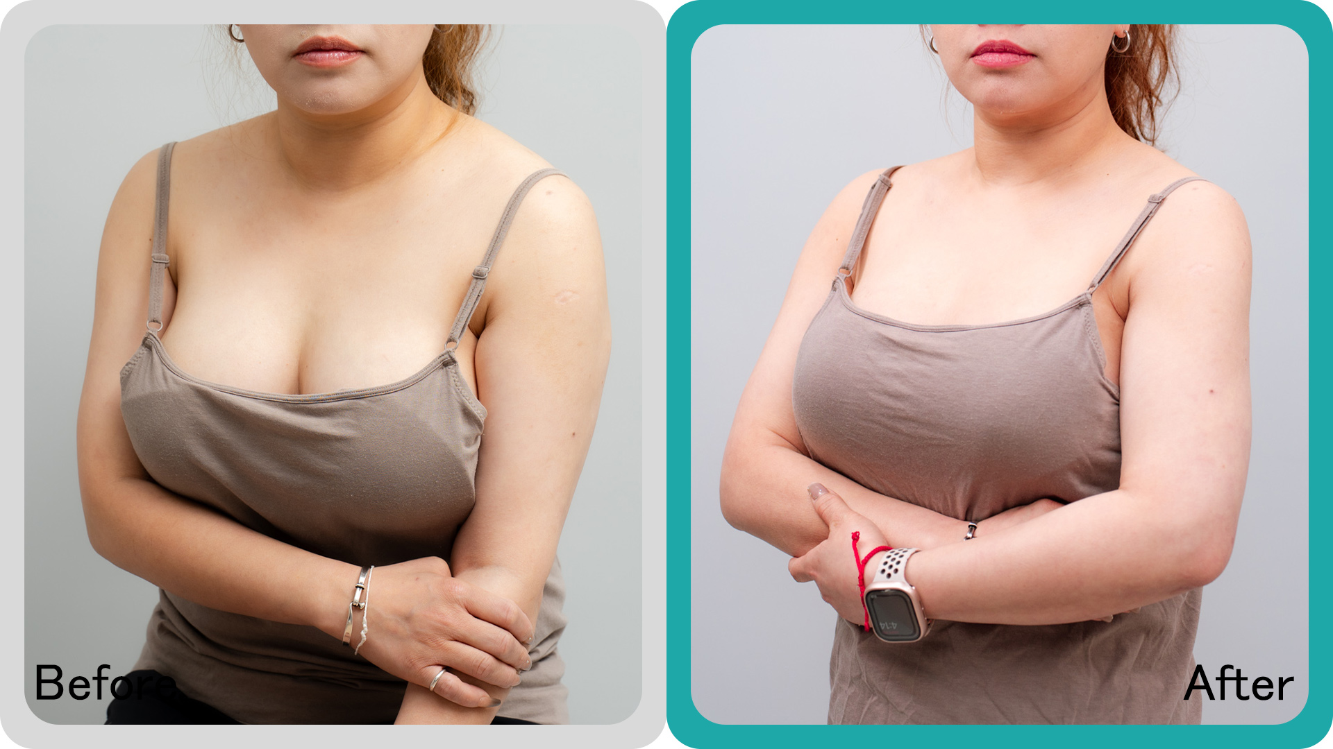 台中縮胸抽脂手術案例