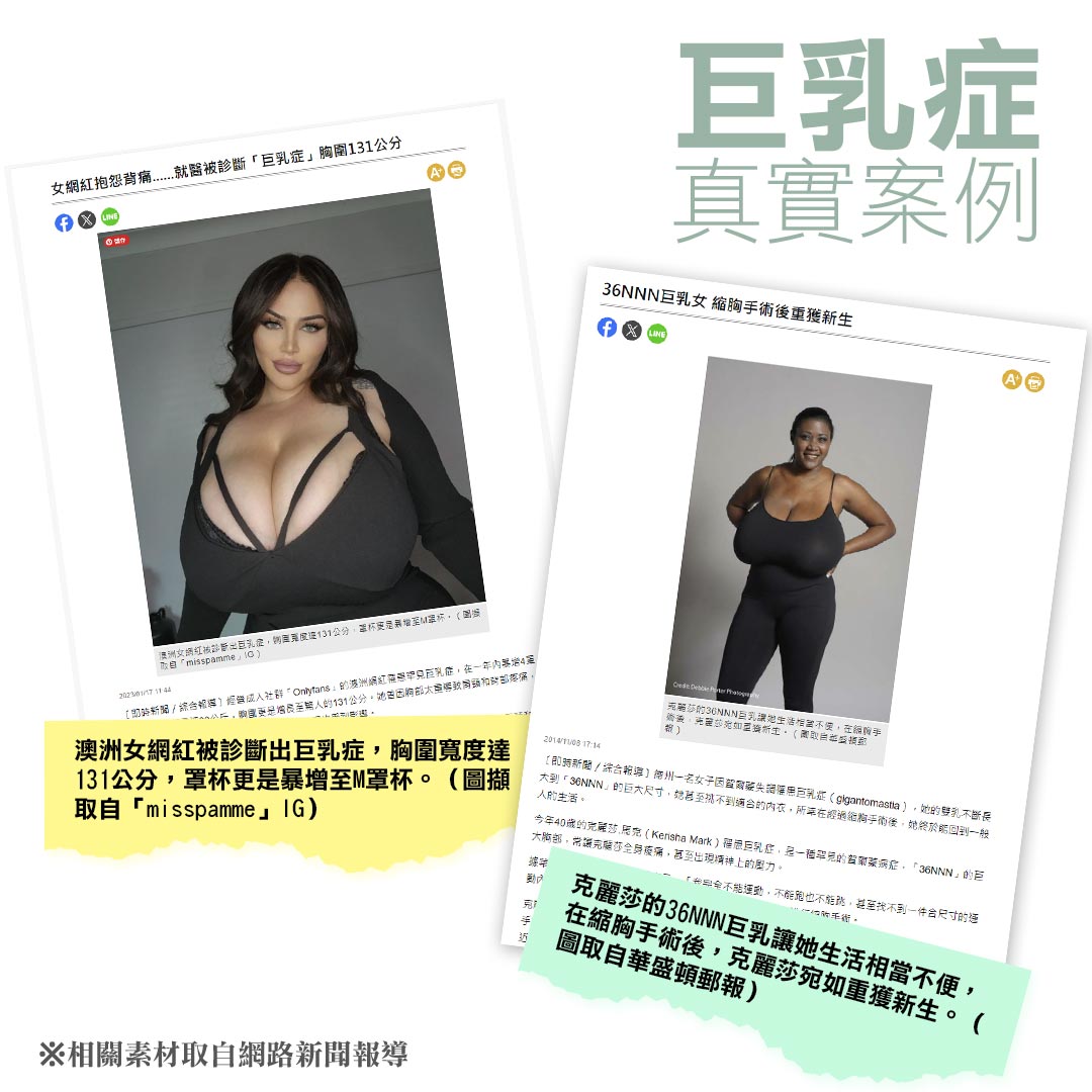 什麼是巨乳症？巨乳症成因？巨乳症新聞相關報導