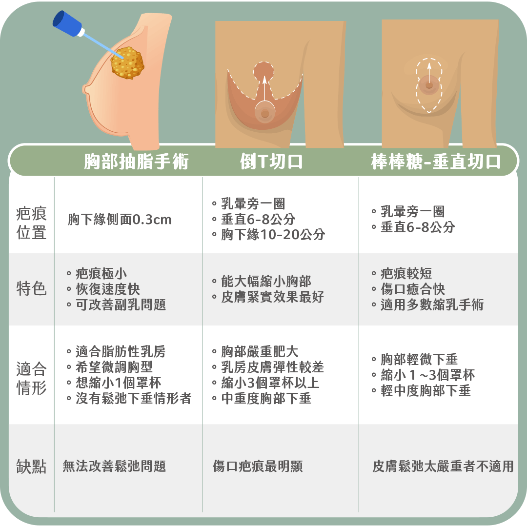 縮乳手術方式介紹（胸部抽脂手術｜倒T切口｜棒棒糖垂直切口）