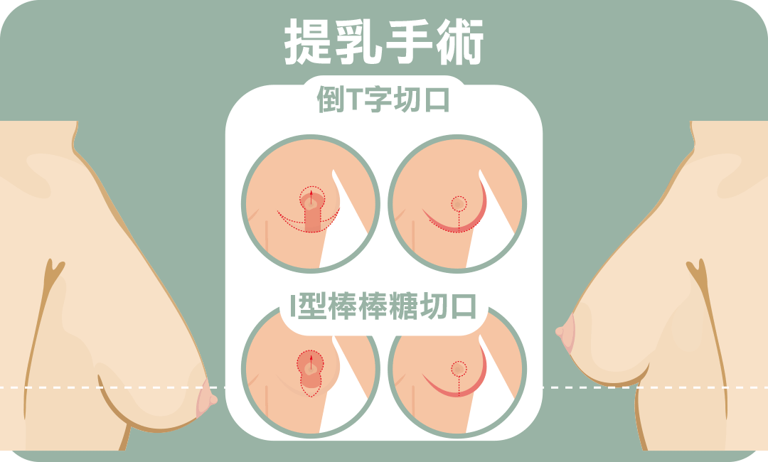胸部下垂怎麼辦
