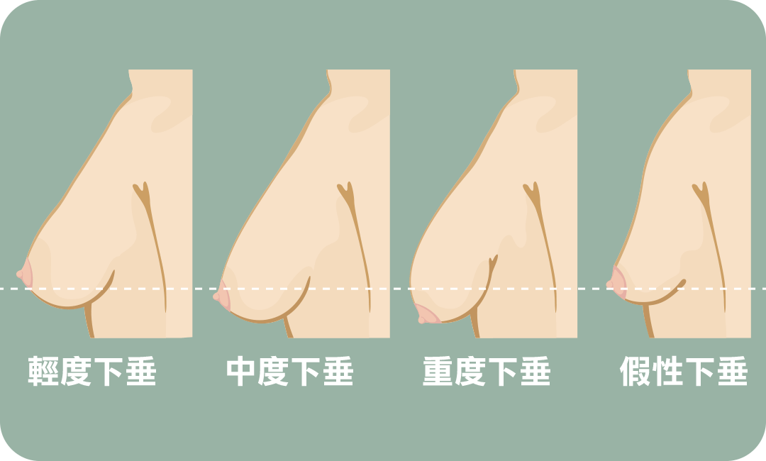 縮乳手術前判斷胸部下垂程度４等級