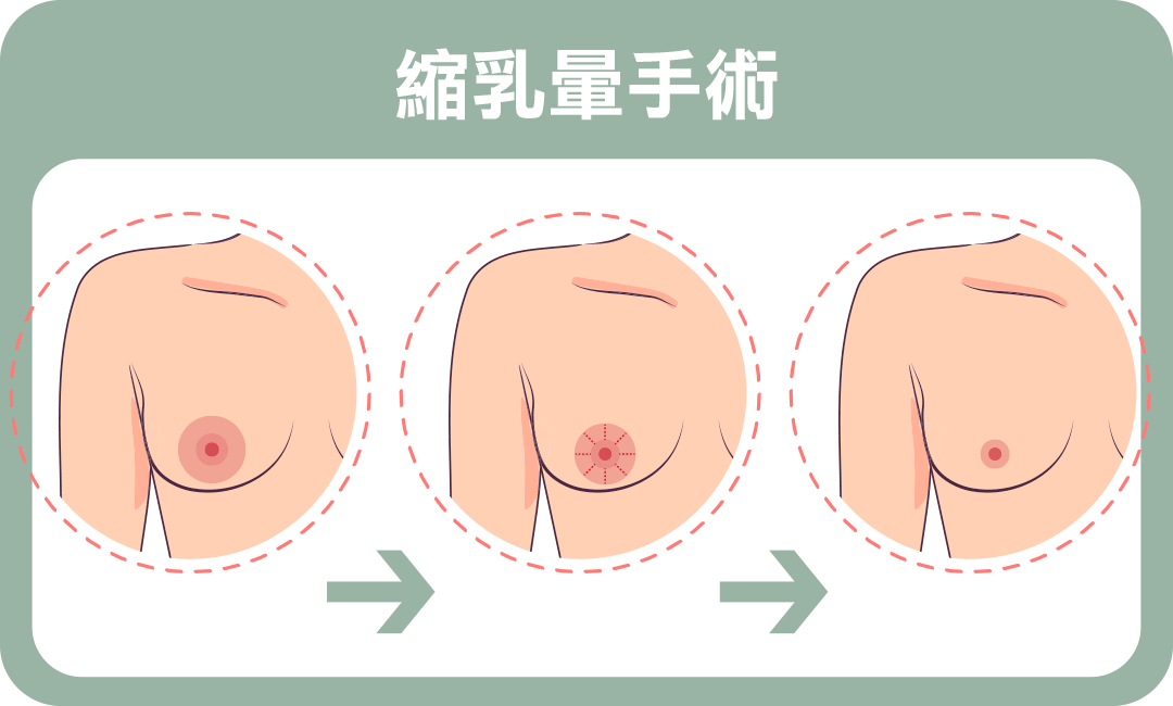 乳暈太大怎麼辦？縮乳暈手術治療方式