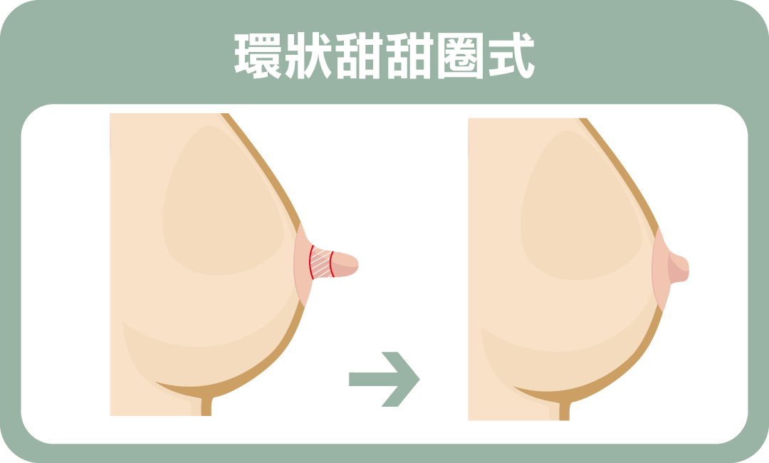 乳頭太長怎麼辦