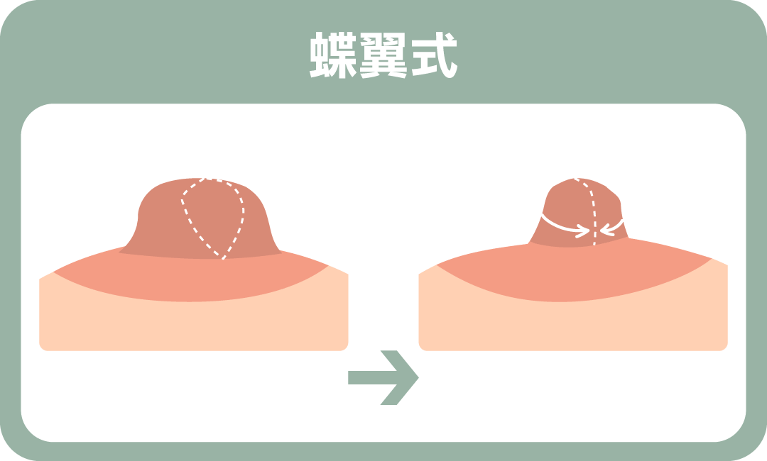 乳頭太寬怎麼辦