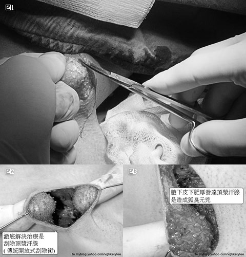 傳統直視下頂漿腺切除術狐臭根除術 VASER威塑除狐臭手術治療