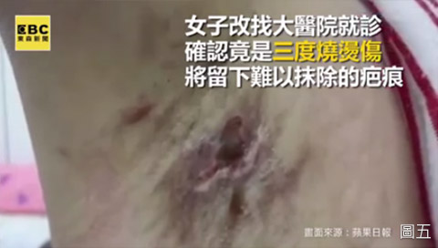 電動旋轉刮刀切除頂漿腺狐臭根除術疤痕 電動旋轉刮刀切除頂漿腺狐臭根除術疤痕