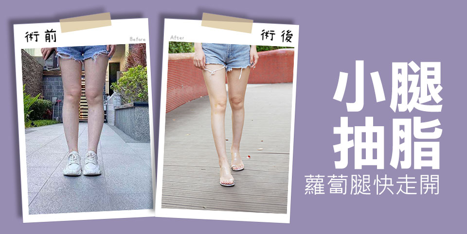 小腿抽脂-打造穠纖合度完美小腿